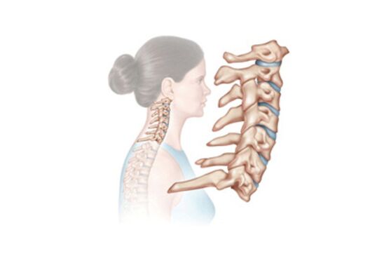 a nyaki gerinc károsodása osteochondrosissal