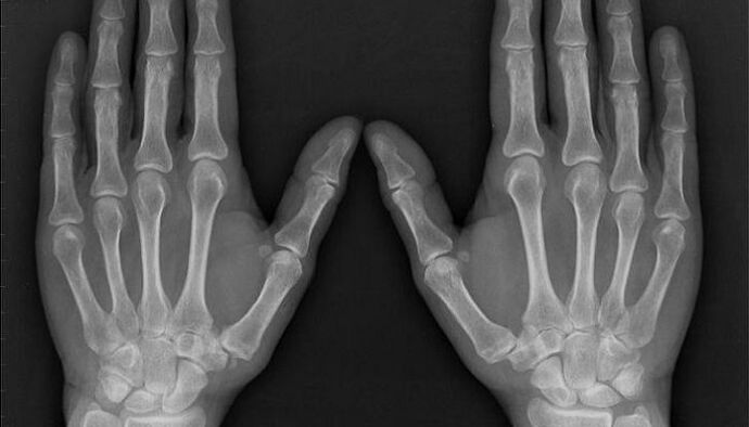 röntgenfelvétel az ízületi gyulladás és az arthrosis diagnosztizálására