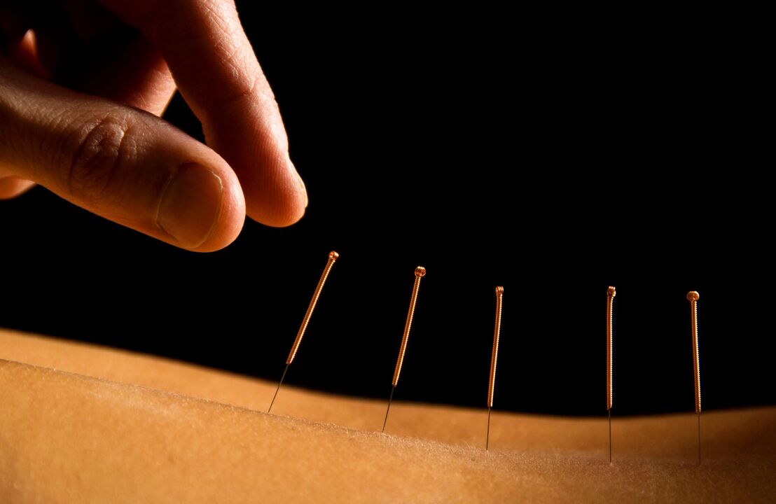 akupunktúra hátfájásra