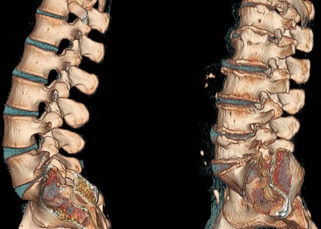 Az ágyéki régió osteochondrosis