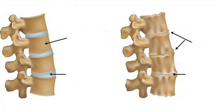ischaemiás szindróma osteochondrosishoz