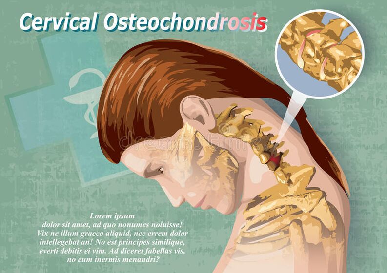 A nyaki osteochondrosis a porcszövet betegsége
