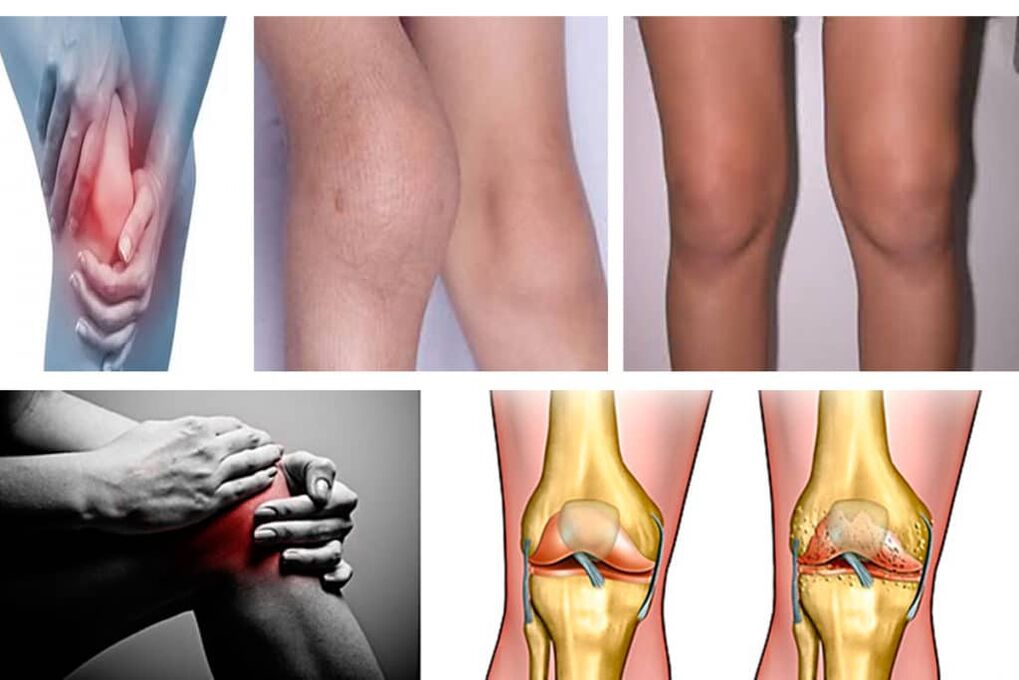 térd arthrosis tünetei